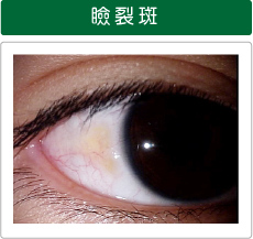 瞼裂斑(けんれつはん)の写真