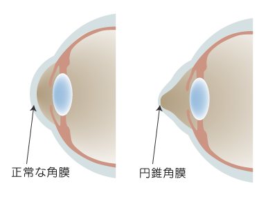 正常な角膜と円錐角膜を比較したイメージイラスト