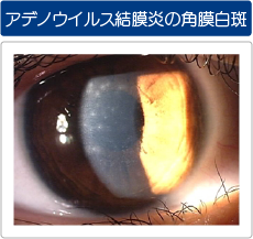 アデノウイルス結膜炎の角膜白斑の写真